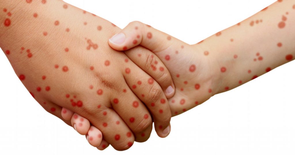 Händer Med Röda Utslag Skakar Hand